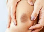 Bukan ‘Dicubit Setan’, ternyata Memar Ini Pertanda Gula Darah Tinggi!