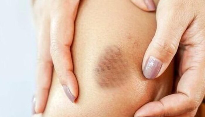 Bukan ‘Dicubit Setan’, ternyata Memar Ini Pertanda Gula Darah Tinggi!