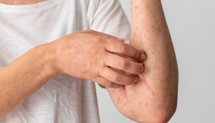 Ketahui  fakta dan makna Hari Lupus Sedunia 2024