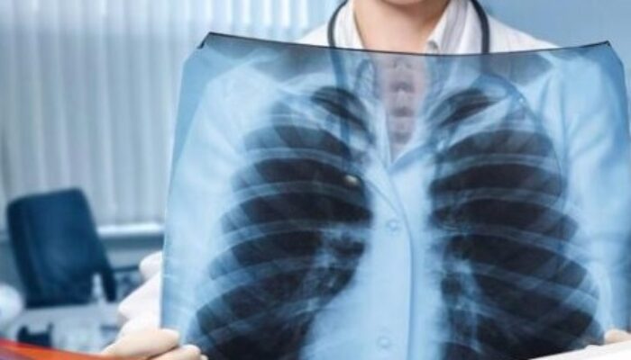 Pemicu Paru-paru Basah salah satunya karena AC, Ini kata Dokter