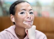Apa itu Vitiligo dan Apakah Bisa Diobati? Ini Kata Dokter