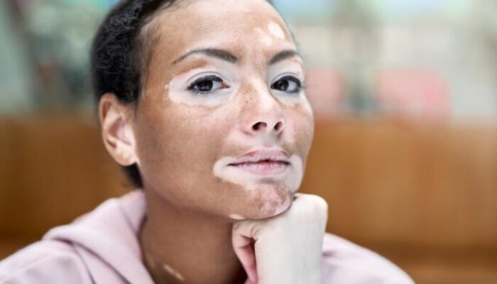 Apa itu Vitiligo dan Apakah Bisa Diobati? Ini Kata Dokter